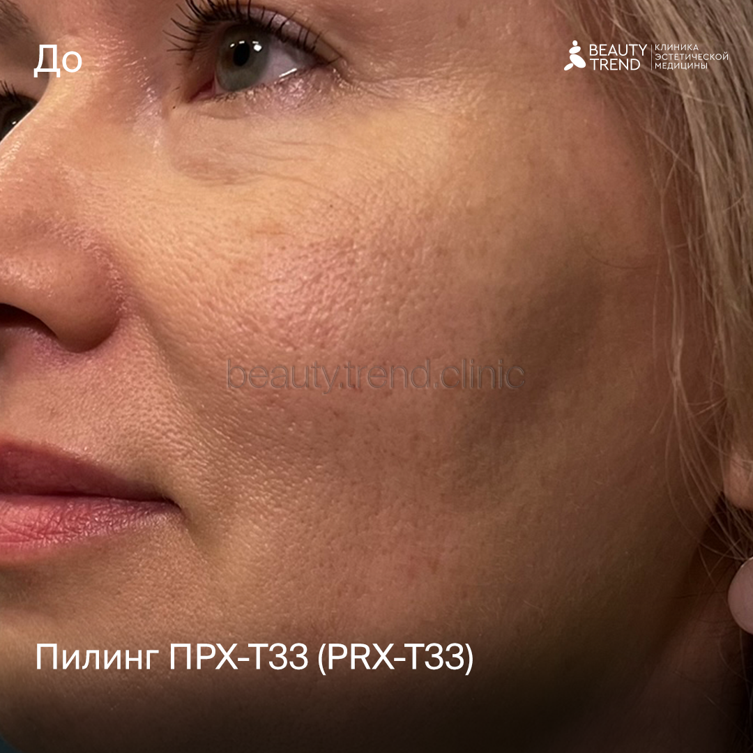 Пилинг PRX - до 1